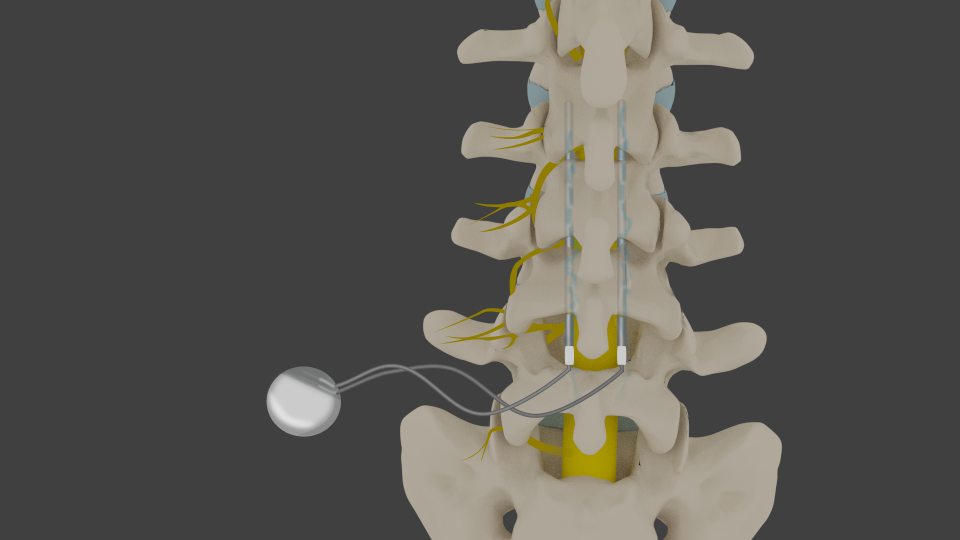 FAQs On Spinal Cord Stimulator Therapy For Failed Back Surgery Syndrome ...