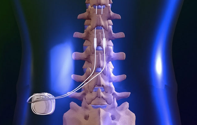 Spinal_Cord_Stimulator3