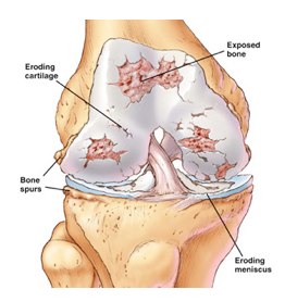 knee arthritis