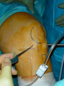 A simple knee scope may lead to RSD