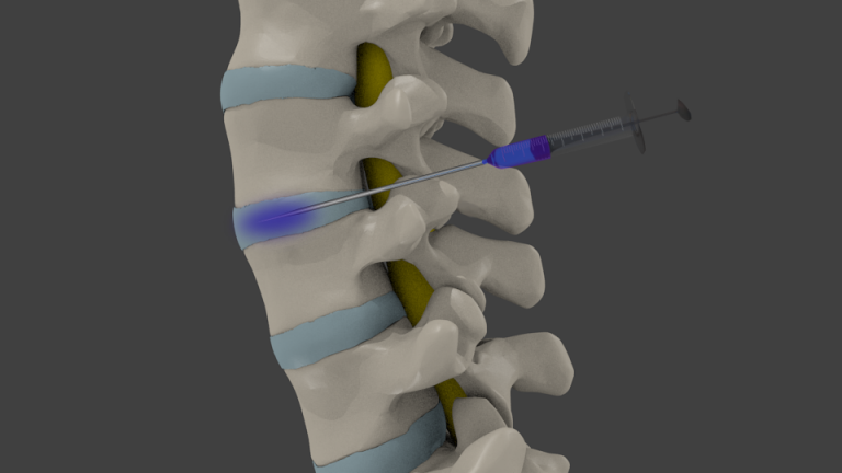 The Basics of Lumbar Discography - Desert Interventional