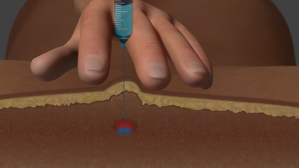 Overview of Trigger Point Injections - Desert Interventional