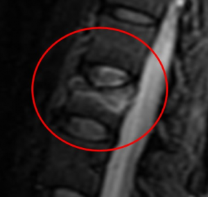 MRI VCF compression fracture